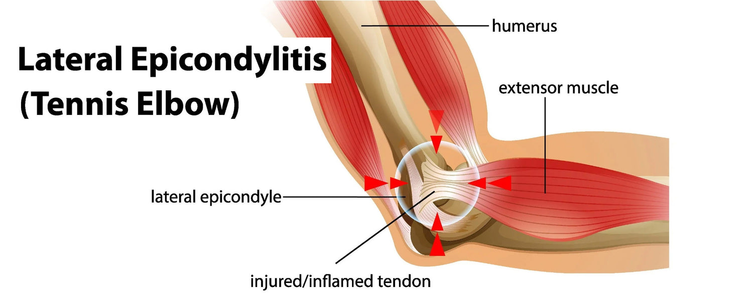 Mastering the Game and Minimizing the Risks: Preventing Tennis Elbow in Pickleball